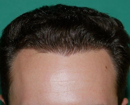 Hair Loss Surgery: 4086 Graft Staged Frontotemporal Restoration - Postop Front