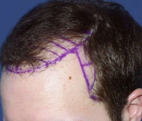 Hair Loss Surgery: 4086 Graft Staged Frontotemporal Restoration - Preop Oblique View