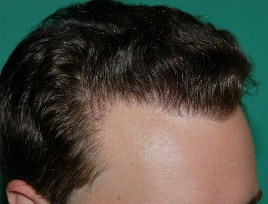 Hair Loss Surgery: 4086 Graft Staged Frontotemporal Restoration - Postop Right Hairline