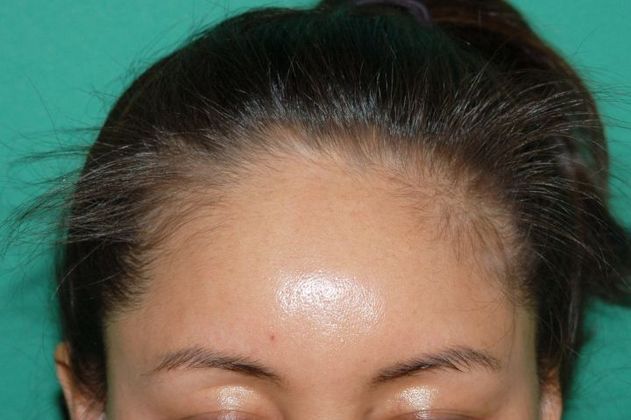 Hair Loss Surgery: 4086 Graft Staged Frontotemporal Restoration - Preop Front