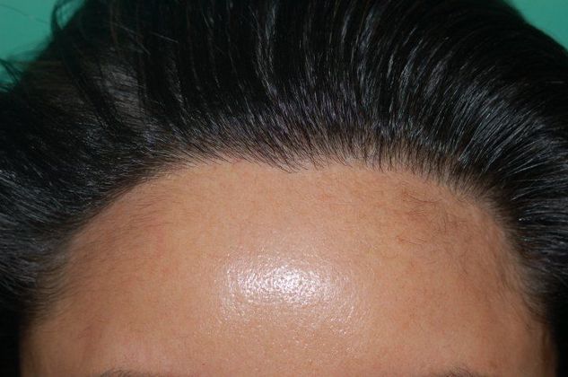 Hair Loss Surgery: 4086 Graft Staged Frontotemporal Restoration - Postop Front Close-Up