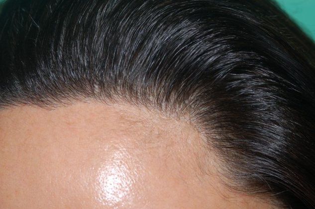 Hair Loss Surgery: 2141 Female Frontal Hairline Advancement Using Dense Pack Grafting - Postop Left Close-Up View