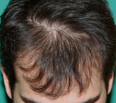 Hair Loss Surgery: 2152 Graft Frontal Hairline Restoration - Preop