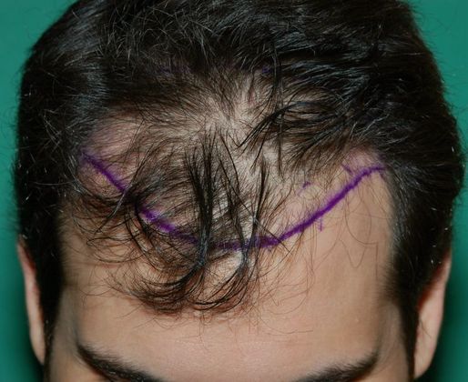 Hair Loss Surgery: 2152 Graft Frontal Hairline Restoration - Preop Hairline Design