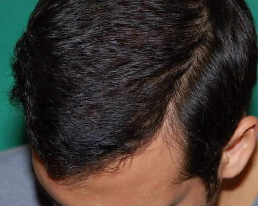 Hair Loss Surgery: 2152 Graft Frontal Hairline Restoration - Postop