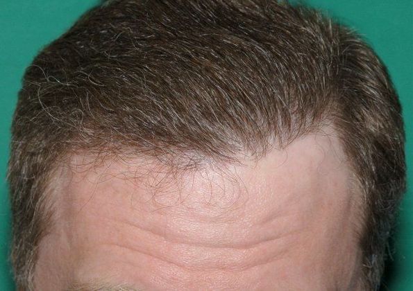 Hair Loss Surgery: 4887 Graft Total Scalp Restoration - Session 1 Front View