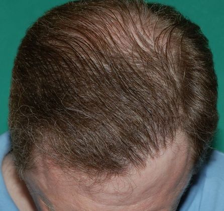 Hair Loss Surgery: 4887 Graft Total Scalp Restoration - Session 1 Top View