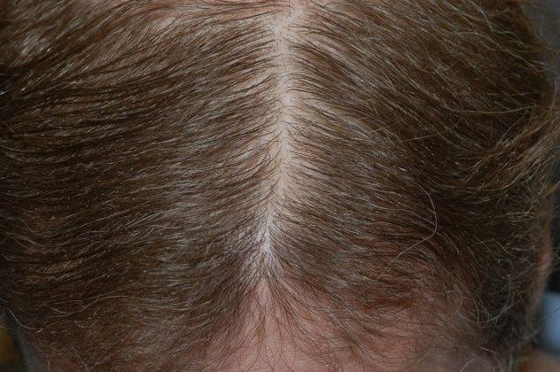 4887 Grafts by Dr. Konior - Hair Loss Surgery - Before and After Gallery
