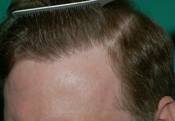 Hair Loss Surgery: 4887 Graft Total Scalp Restoration - Postop Side Comb-Back View