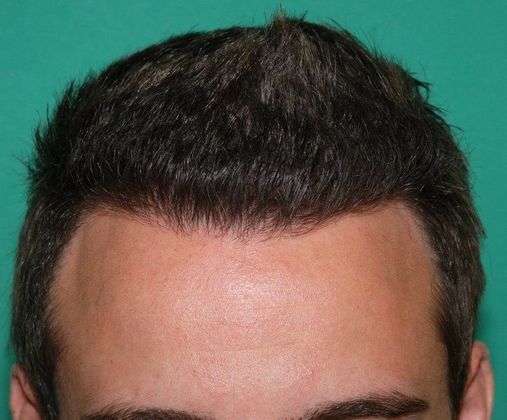 Hair Loss Surgery: 2953 Graft Dense-Pack Frontal Hairline Restoration - Postop Front View 2