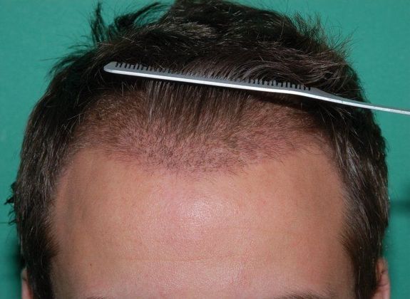 Hair Loss Surgery: 2953 Graft Dense-Pack Frontal Hairline Restoration - One Week Postop View of Graft Zone