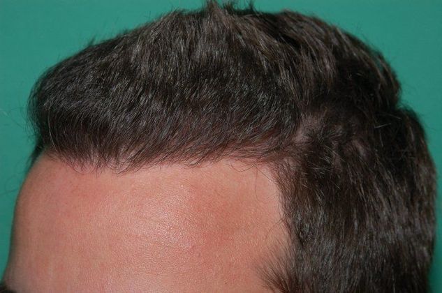 Hair Loss Surgery: 2953 Graft Dense-Pack Frontal Hairline Restoration - Postop Left