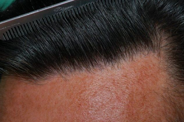 Hair Loss Surgery: 2247 Graft Hairline Repair - Postop Left Close-up