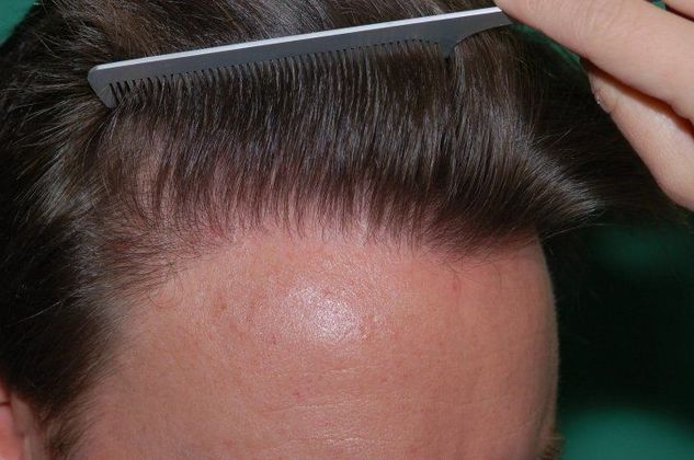 Hair Loss Surgery: 3165 Graft High Density Frontal Restoration - Right Comb-Back 2