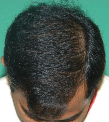 Hair Loss Surgery: 4016 Graft Total Scalp Restoration - 10 Month Postop