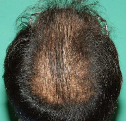 Hair Loss Surgery: 4016 Graft Total Scalp Restoration - Preop Top