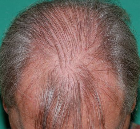 Hair Loss Surgery: 2912 Frontal and Midscalp Restoration - Preop Top 2