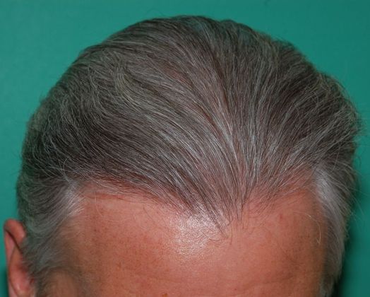 Hair Loss Surgery: 2912 Frontal and Midscalp Restoration - Right - Hair Combed Back