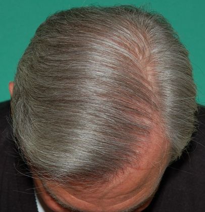 Hair Loss Surgery: 2912 Frontal and Midscalp Restoration - Top - Hair Parted