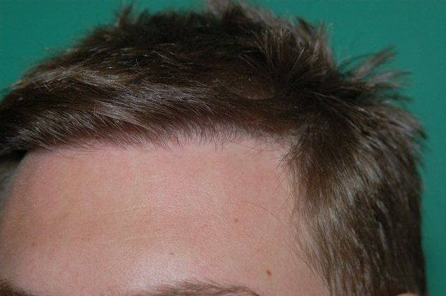 Hair Loss Surgery: 2635 High Density Frontal Restoration - Postop Left View - Dry Hair