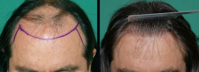 Hair Loss Surgery: 5053 Graft Total Scalp Restoration - Preop - Postop Comparison