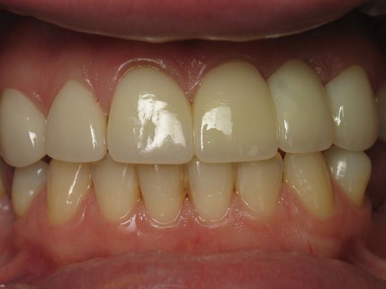 Dental Implants Patient #3 - After