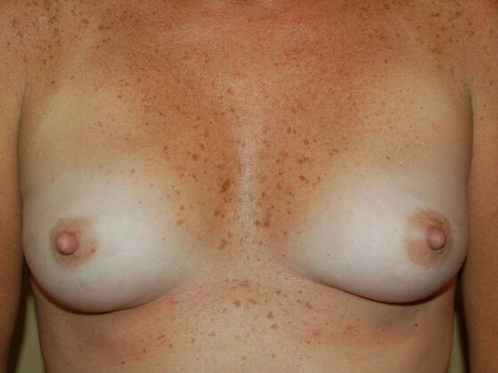 Breast Augmentation Case 2 - Before