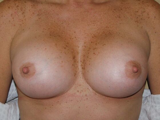 Breast Augmentation Case 2 - After