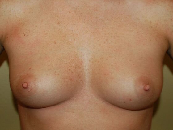 Breast Augmentation: Case 5 - Before Breast Augmentation