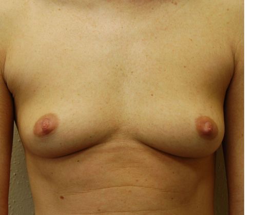 Breast Augmentation Case 8 - Before