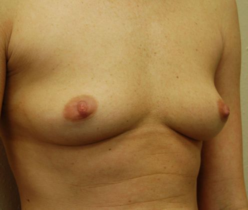 Breast Augmentation: Case 8 - Before Breast Augmentation