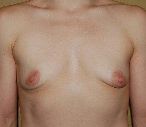 Breast Augmentation Case 803  - Before
