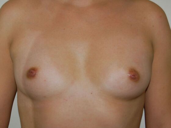 Breast Augmentation Case 13 - Before