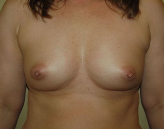 Breast Augmentation Case 679 - Before
