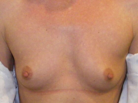 Breast Augmentation Case 21 - Before