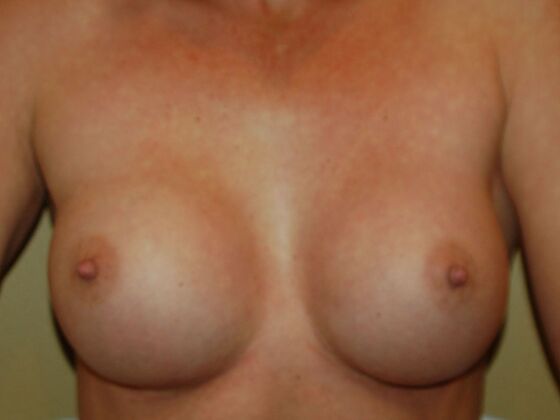 Breast Augmentation Case 21 - After