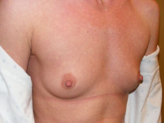 Breast Augmentation: Case 21 - Before Breast Augmentation