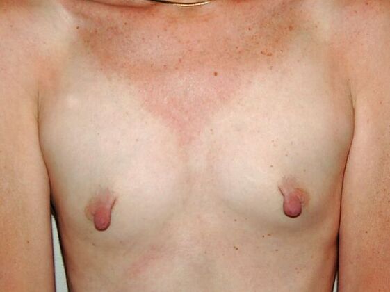 Breast Augmentation Case 25 - Before