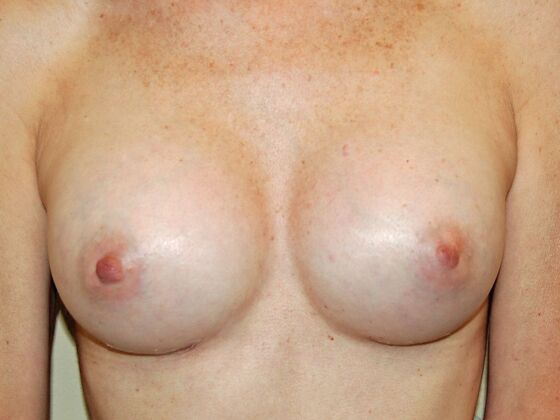Breast Augmentation Case 25 - After