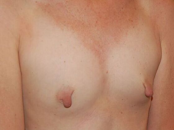 Breast Augmentation: Case 25 - Before Breast Augmentation