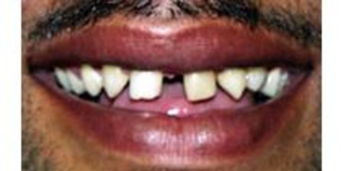 Replacing Missing Teeth Case 1 - Before