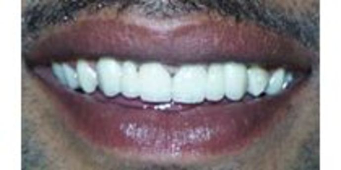 Replacing Missing Teeth Cases