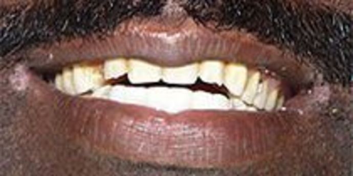 Dentures Case 1 - Before