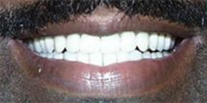 Dentures Case 1 - After