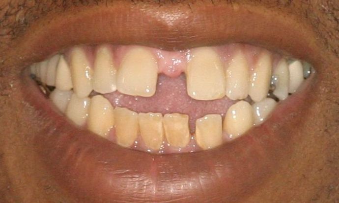 Orthodontics Case 1 - Before