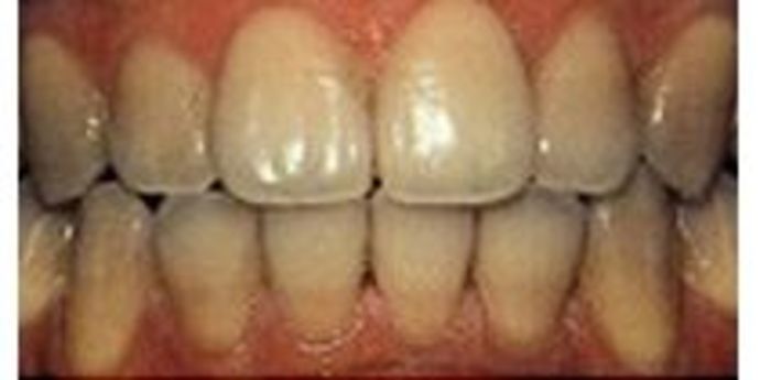 Teeth Whitening Case 1 - Before