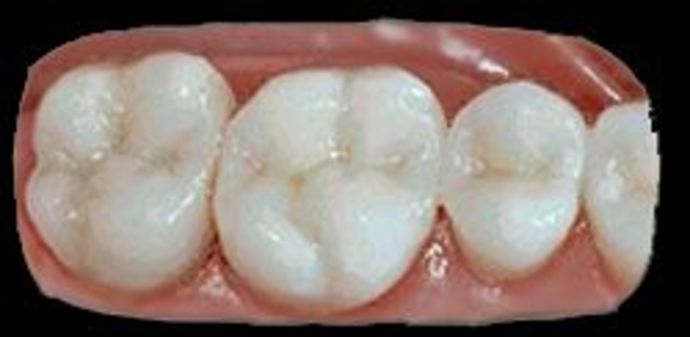 Tooth Colored Fillings Case 1 - After
