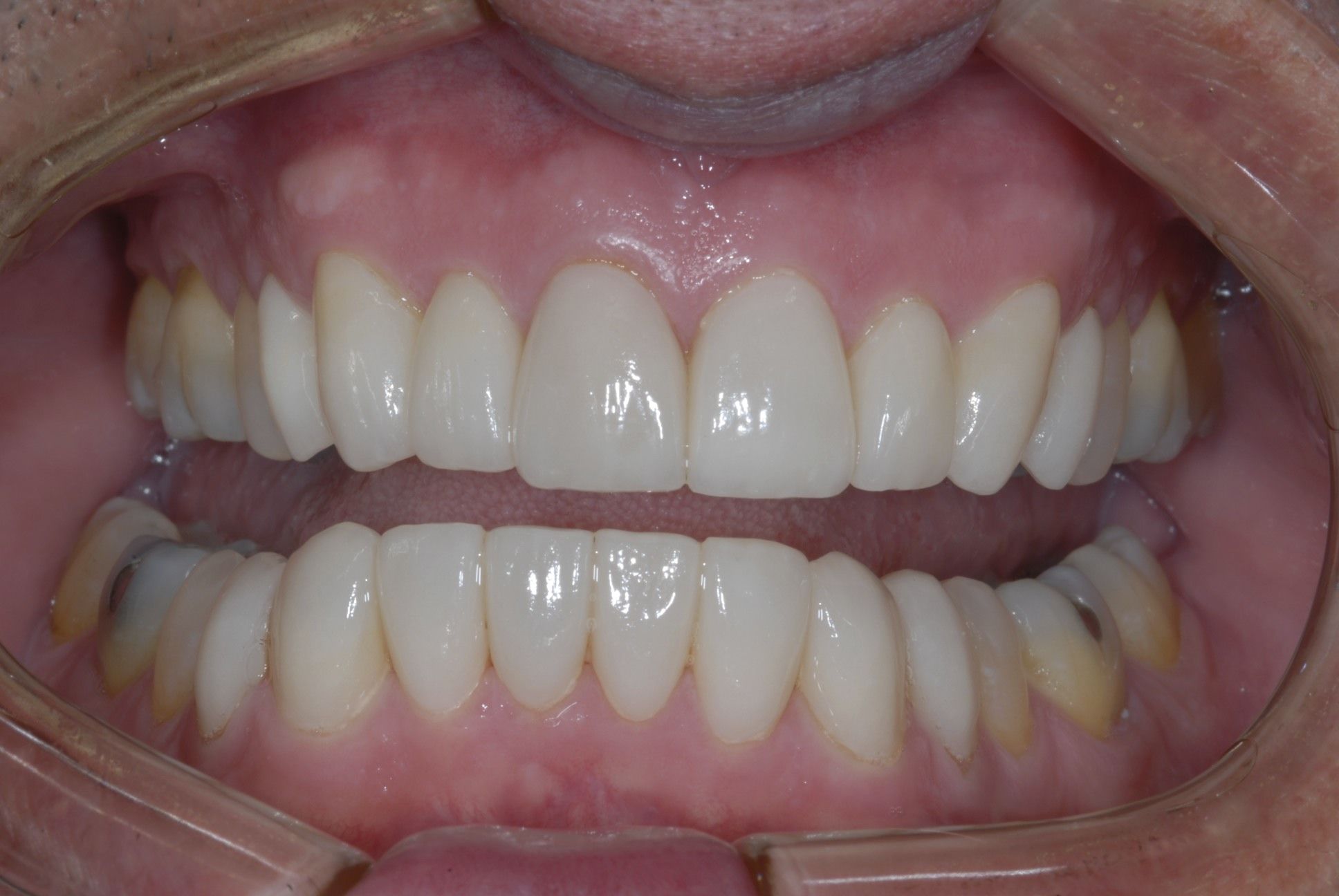 after dental treatment