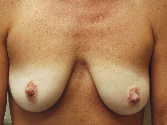 Breast Augmentation w/ Lift Case 32 - Before