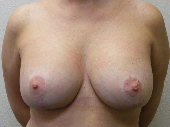 Breast Augmentation w/ Lift Case 34 - After